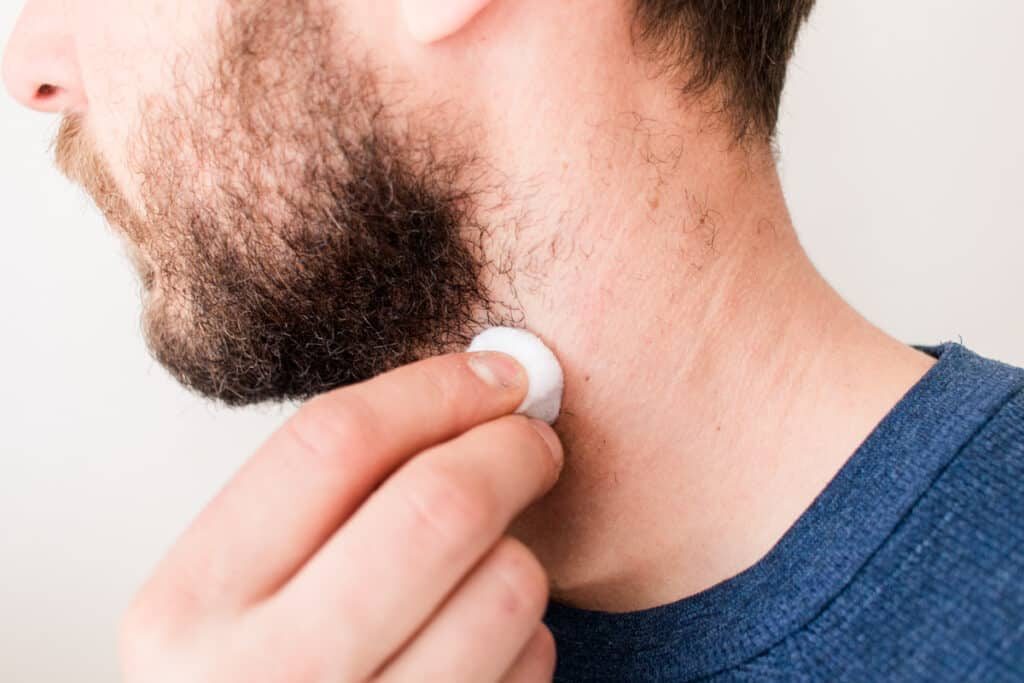 Dabbing tea tree oil onto the skin.